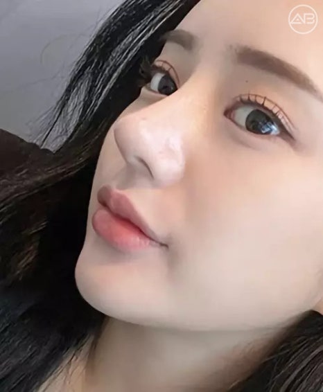 에이비성형외과 자려한 비주라인 코성형수술 관련 이미지 2