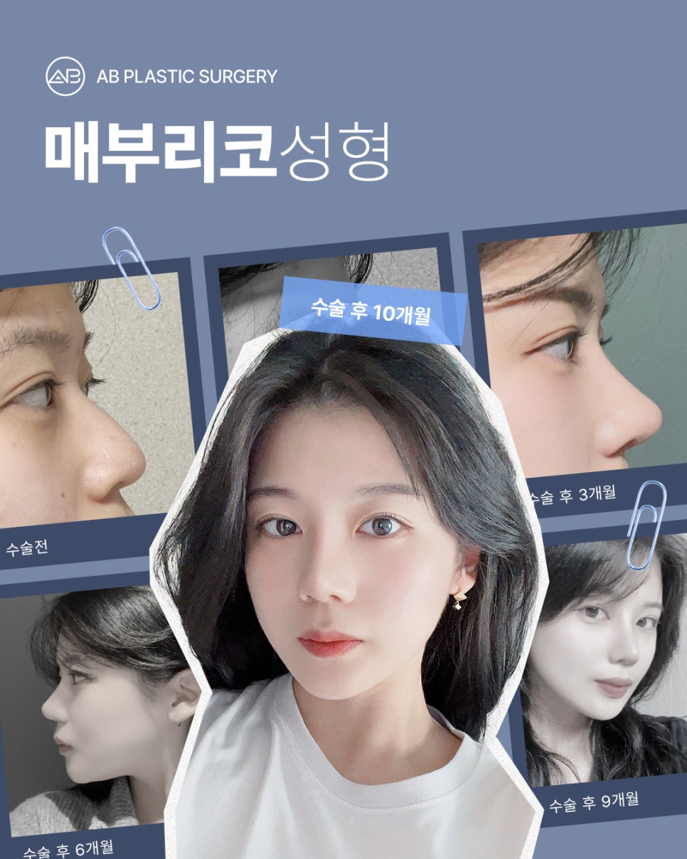 매부리코성형 자연스럽게 교정 원한다면 AB성형외과 관련 이미지 1