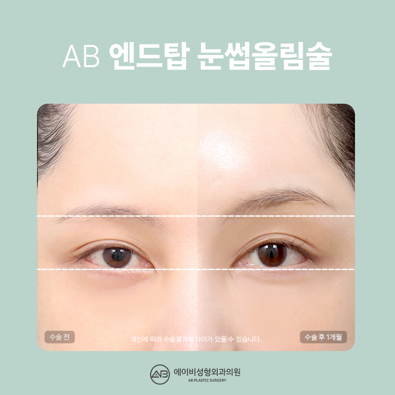 What Is the Endtop Eyebrow Lift That So Many People in Their 20s and 30s Are Getting? image 1