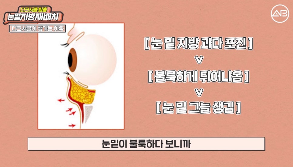 #에이비성형외과#에이비TV#눈성형#눈밑지방재배치 관련 이미지 2