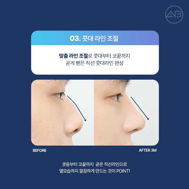 남자직선코성형 왜 에이비성형외과일까? 관련 이미지 7