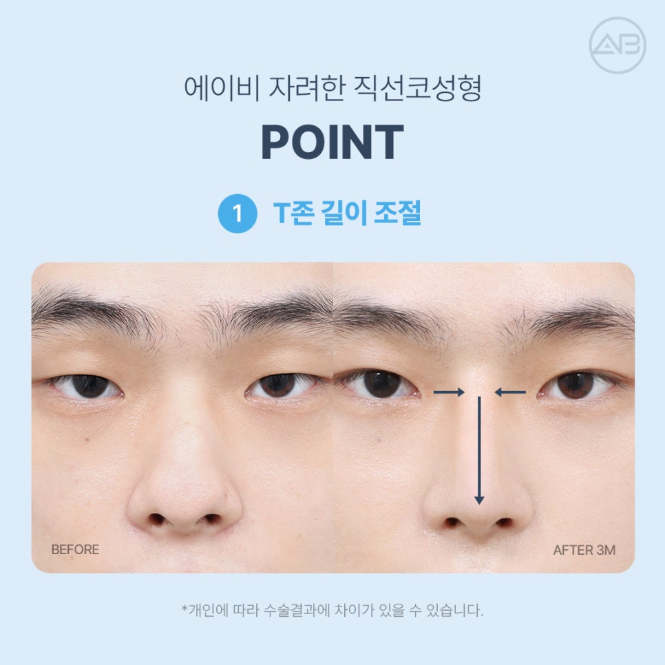 AB성형외과 자려한직선코성형 원조는 다르네 관련 이미지 3