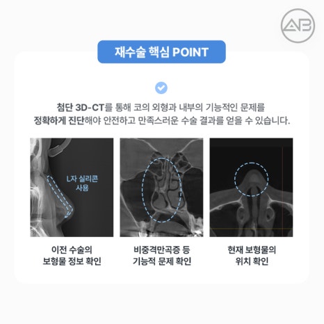 코재수술 필요하다면 에이비성형외과 관련 이미지 9
