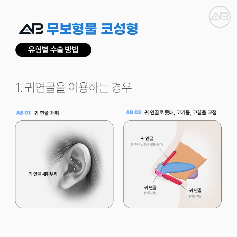 무보형물코성형 임상경험이 풍부한 에이비성형외과 관련 이미지 4