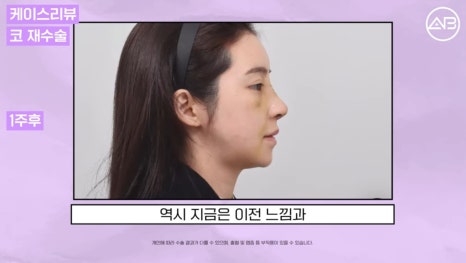 #AB Plastic Surgery #AB TV #Case Review #Nose Surgery #Revision Rhinoplasty image 6