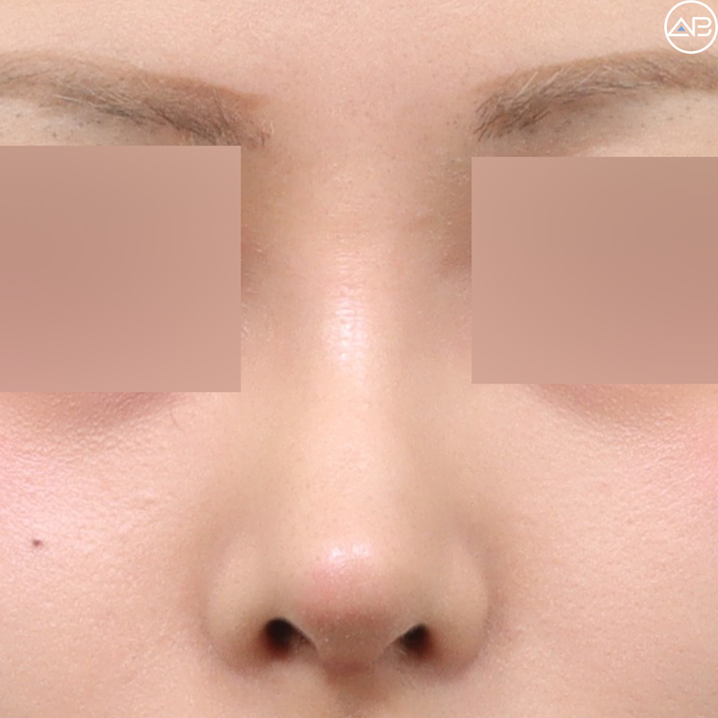 AB Plastic Surgery Natural Glamorous Rhinoplasty Case Review (Feat. Dr. Jo Gyu-sang) image 4
