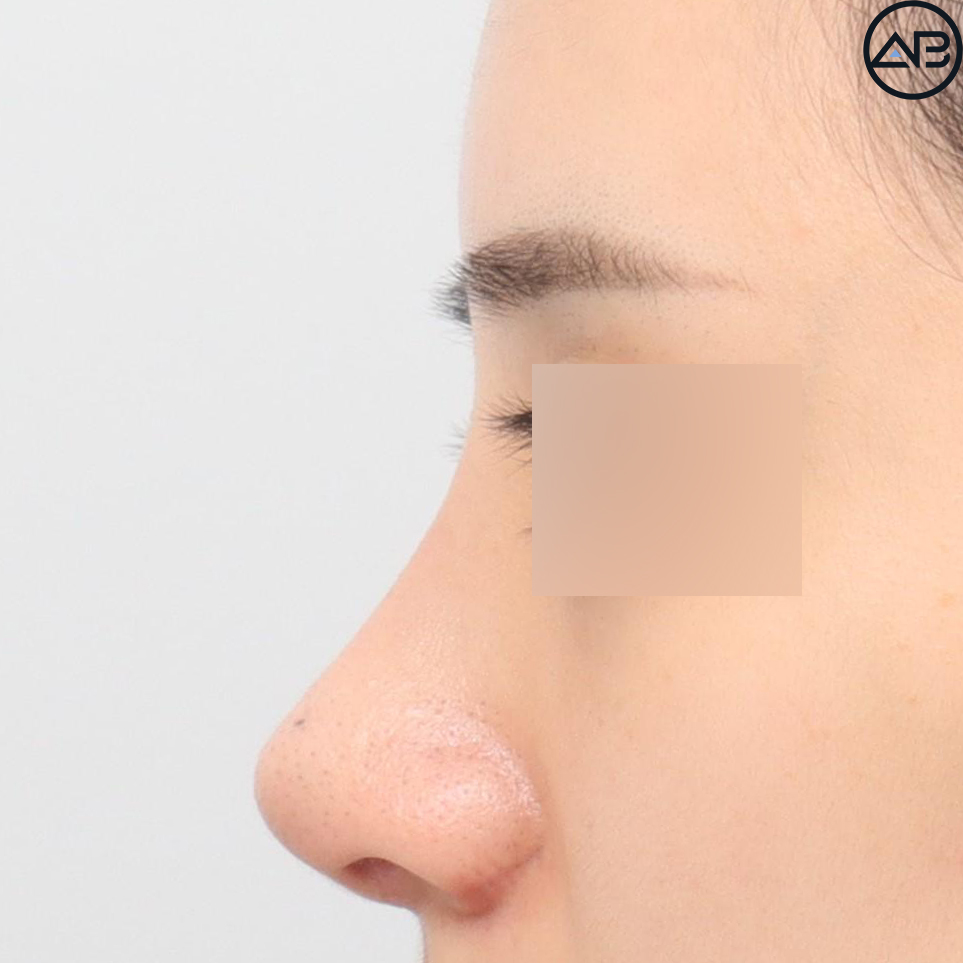 AB Plastic Surgery Refined Rhinoplasty - Revision Surgery Case Review image 6