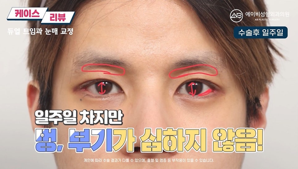 #에이비성형외과#에이비tv#눈성형#남자눈성형 관련 이미지 6