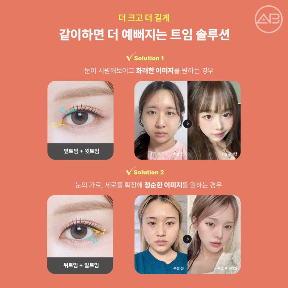 AB Plastic Surgery Eye Corner Surgery: Types and Reviews of Epicanthoplasty, Canthoplasty, and Lower Canthoplasty image 6