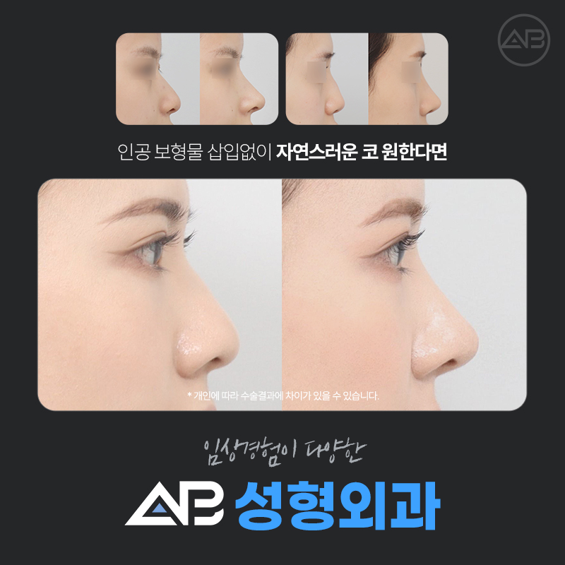 무보형물코성형 임상경험이 풍부한 에이비성형외과 관련 이미지 1