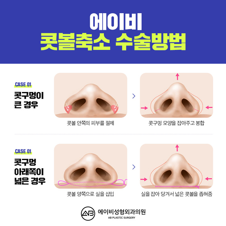 Before and After Nostril Reduction Surgery: AB Is Uncompared image 4