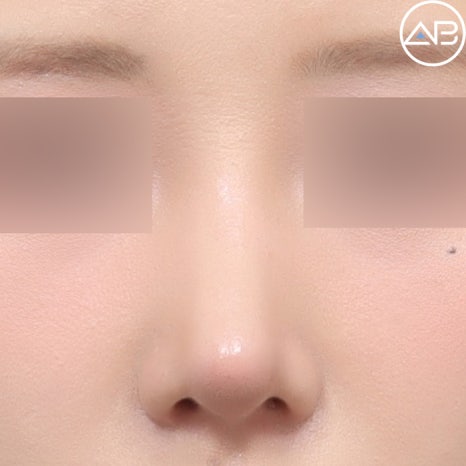 AB Plastic Surgery Low Nose Rhinoplasty Case Review (Feat. Director Seo Chan-eol) image 3