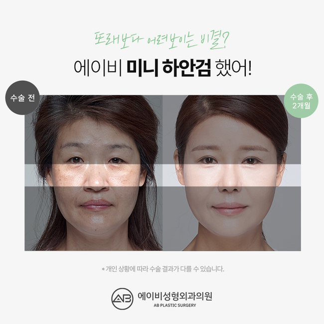 Differences in AB Plastic Surgery’s Mini Lower Blepharoplasty image 7