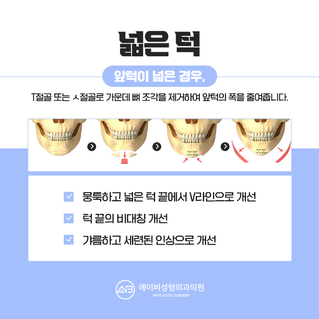 Why You Should Thoroughly Research Chin Surgery Before Having It image 3