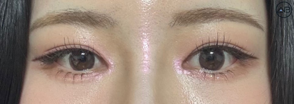 비절개눈매교정+앞트임+뒤트임+밑트임 성형케이스 리뷰 관련 이미지 5