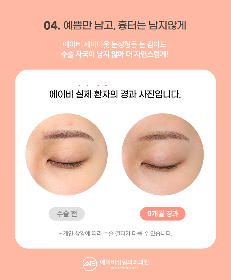 요즘 대세 세미아웃 눈성형 성공하려면? 관련 이미지 8