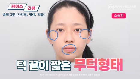 #에이비성형외과#에이비tv#케이스리뷰#윤곽3종수술 관련 이미지 2