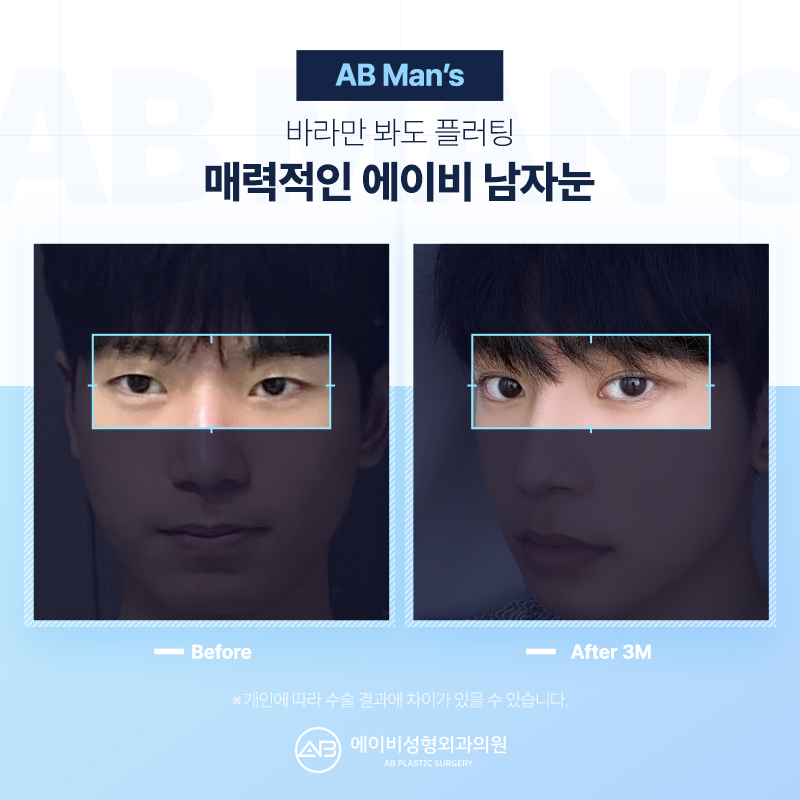 남자눈매교정 잘하는 에이비성형외과 다른점은 뭘까? 관련 이미지 2