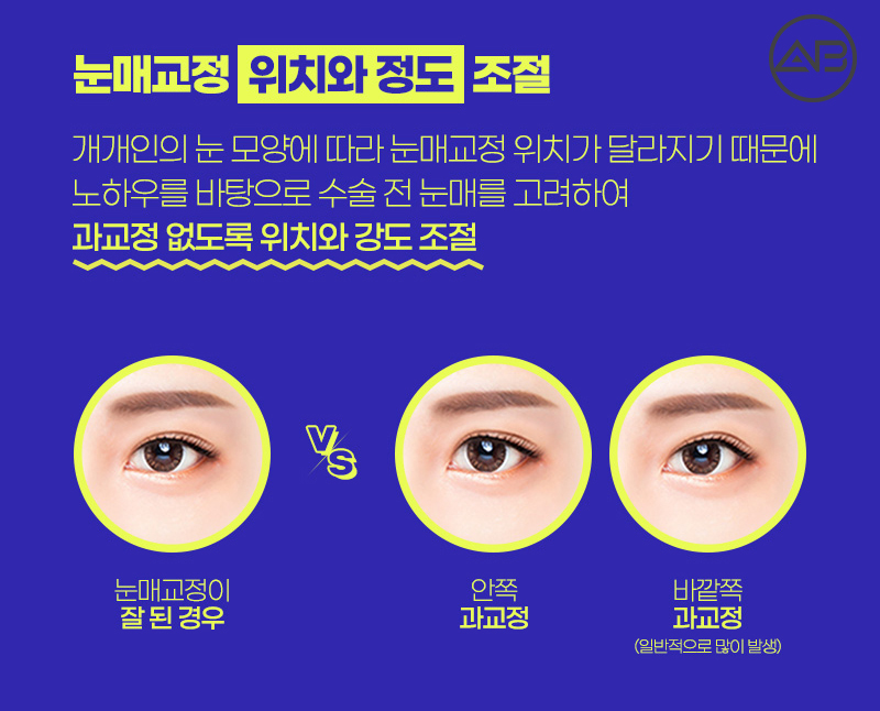 남자쌍수후기 시원하고 자연스럽게 에이비성형외과 관련 이미지 6