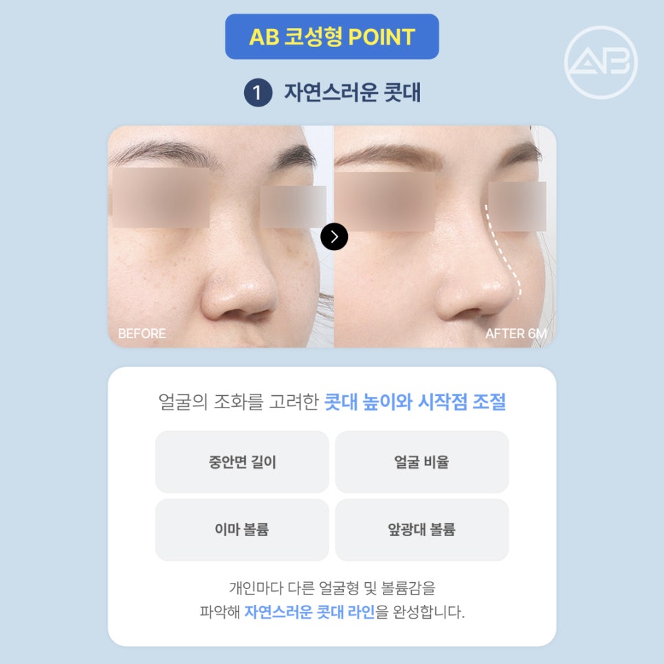에이비성형외과 코끝처짐교정 원인부터 비주교정수술 비순각교정 핵심 정리 관련 이미지 2