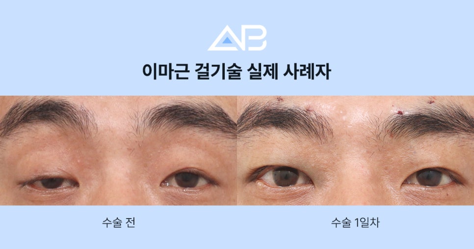 [눈매교정 하면 안되는 이유, 중증 안검하수의 진실] 관련 이미지 4