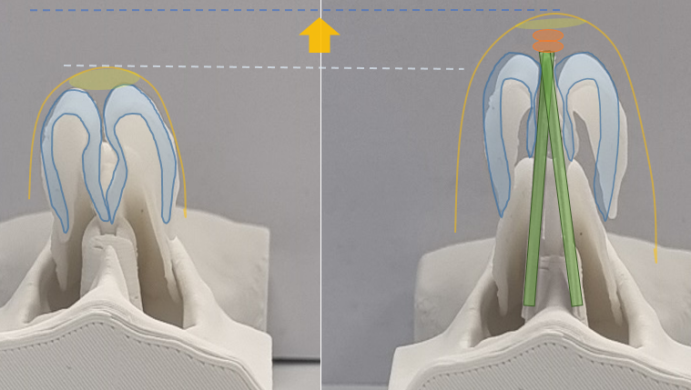 Q. Nose tip surgery, alar reduction, and bulbous nose surgery all look similar. Are they different surgeries? image 5