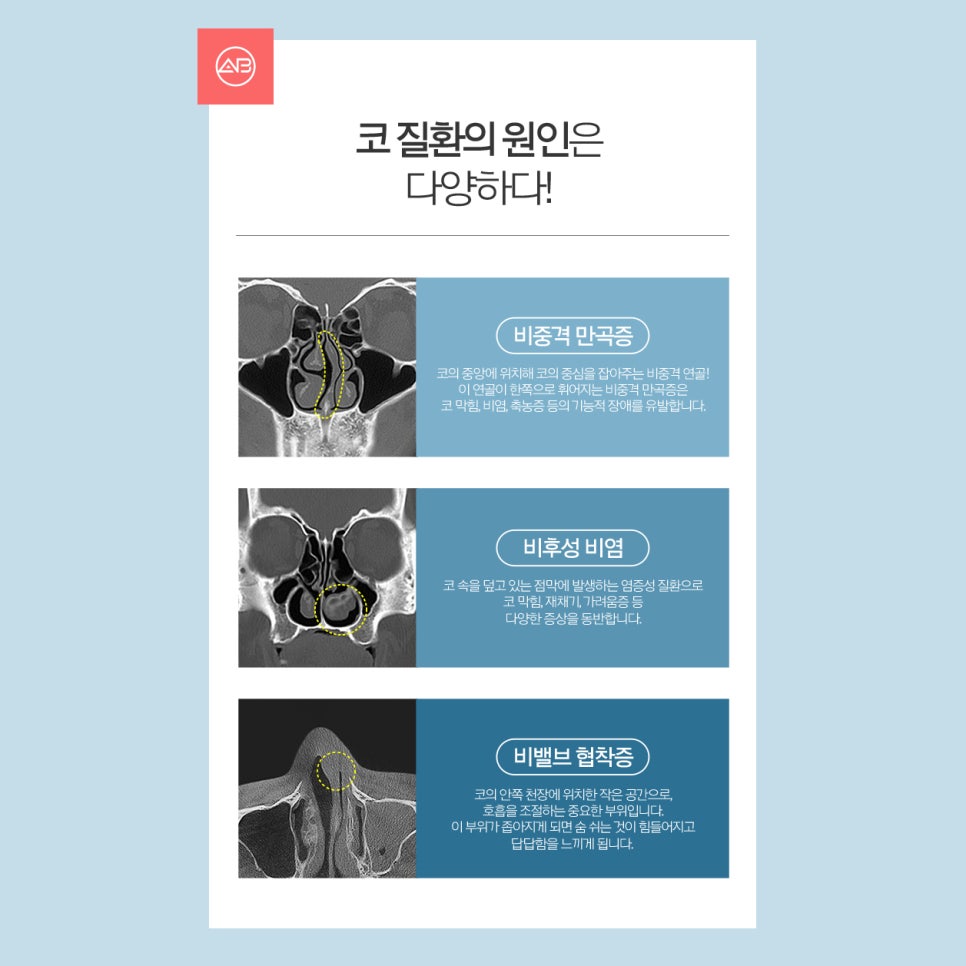 [칼럼] 비중격만곡은 무엇이고, 코성형과 어떤 연관성이 있을까? 관련 이미지 2