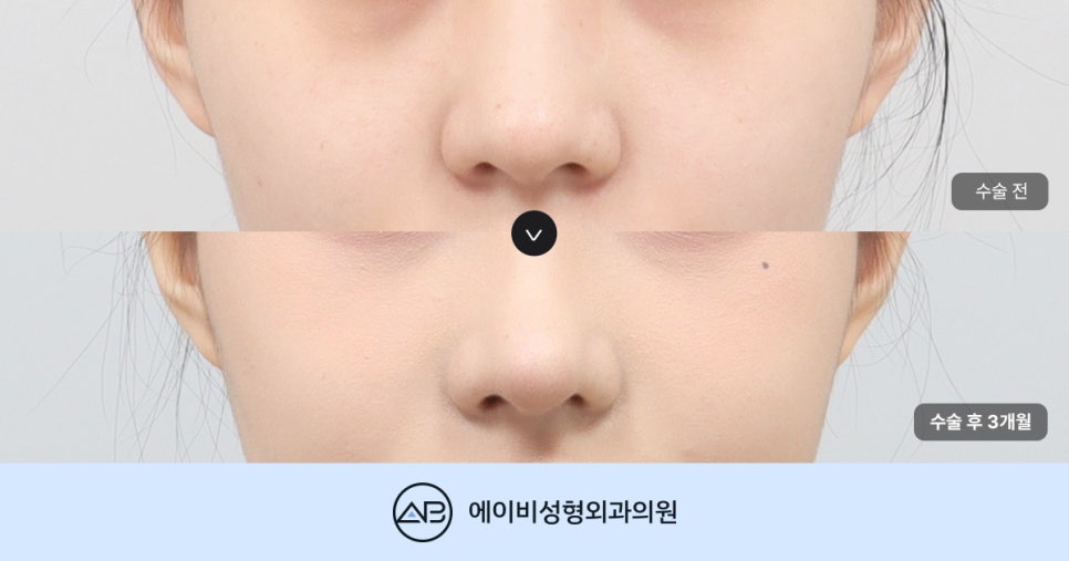 복코성형 전후효과 보려면? (Faet. 에이비성형외과 서찬얼원장) 관련 이미지 1