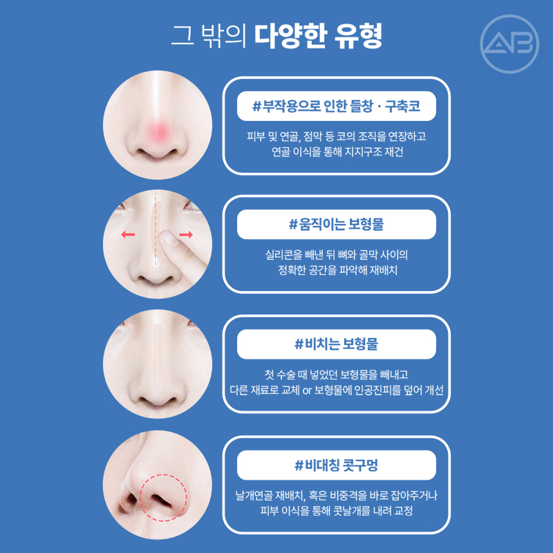 코재수술 필요하다면 에이비성형외과 관련 이미지 6