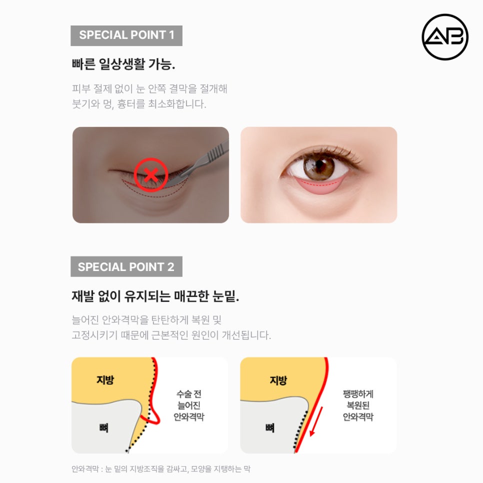 AB Plastic Surgery Under-Eye Fat Repositioning: Effects on Dark Circles and Hollow Under-Eyes, Before-and-After Results, and Side Effects image 3