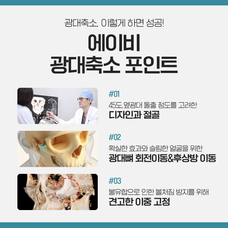 남자광대축소술 다르게 접근해야 관련 이미지 5