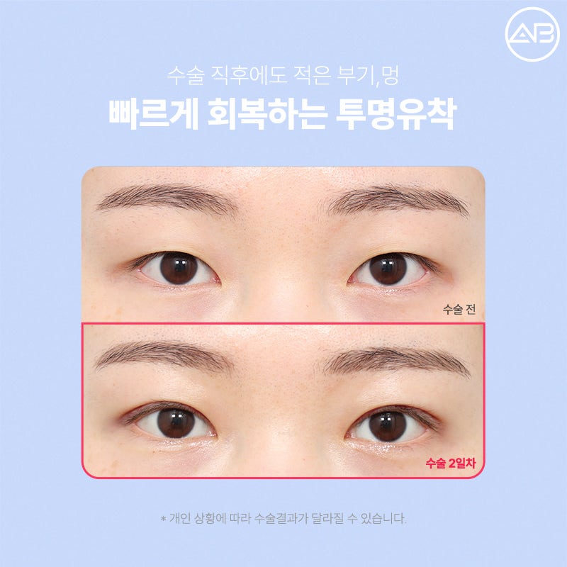처음부터 예뻤던 것처럼, 에이비성형외과 자려한투명유착 관련 이미지 6