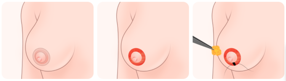 [Breast Reduction Surgery] I Want to Know Where Scars Form on the Breast.. image 2