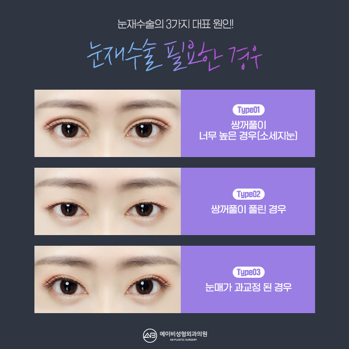 눈재수술비용 얼마인지 궁금해? 관련 이미지 2