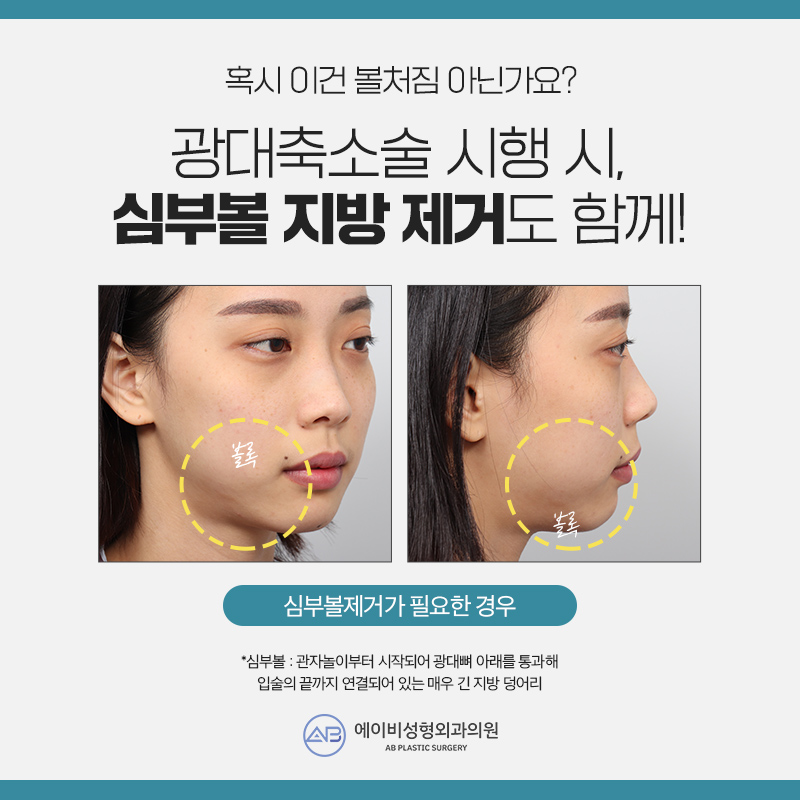 남자광대축소술 다르게 접근해야 관련 이미지 4
