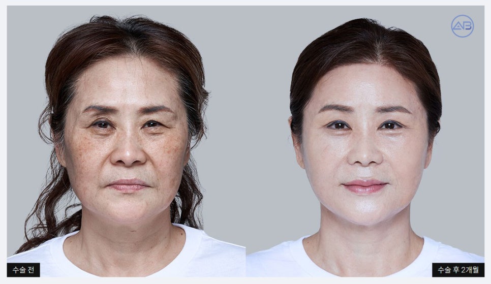 [에이비성형외과 방송출연] 관련 이미지 7