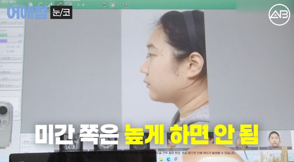 에이비성형외과 맥미걸(MAKEMEGirl) 맥미돌 코성형 상담 과정 관련 이미지 8