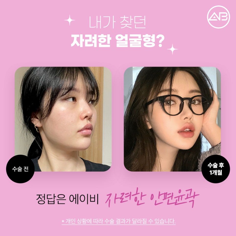 자려한안면윤곽 원한다면 AB성형외과 관련 이미지 2