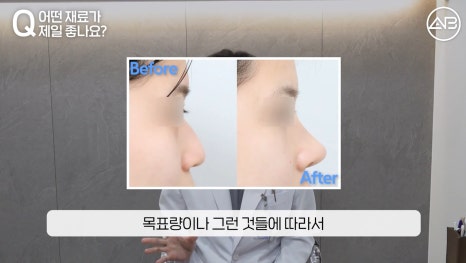 #AB Plastic Surgery #AB TV #Nose Surgery #First Nose Surgery image 9