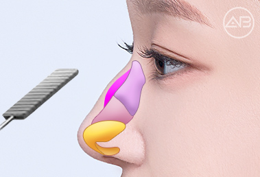 Learn About and Decide on AB Plastic Surgery’s Hump Nose Correction and Implant-Free Rhinoplasty image 5