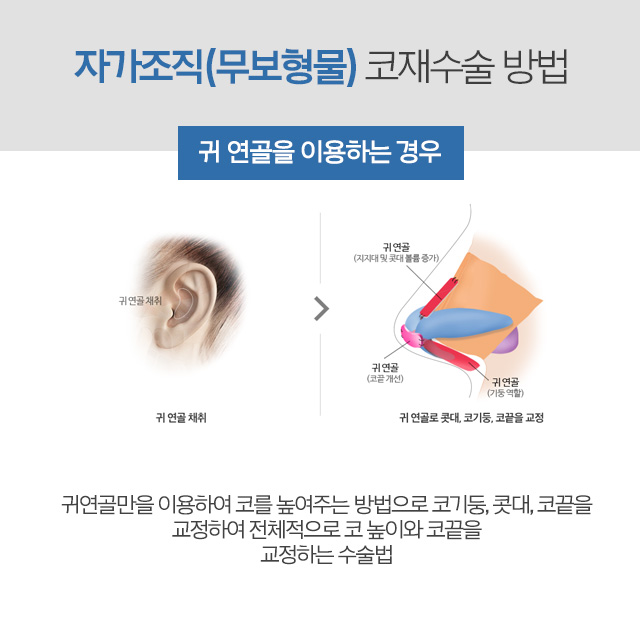 코재수술비용 고민이라면 AB성형외과에서 알아봐 관련 이미지 6