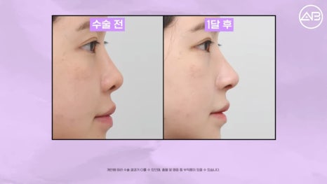#AB Plastic Surgery #AB TV #Case Review #Nose Surgery #Revision Rhinoplasty image 9
