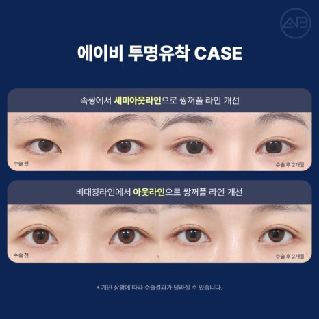 Transparent Adhesion for a Refined Look: AB Plastic Surgery for Attractive Eyes image 9