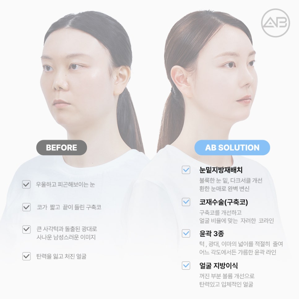 AB Plastic Surgery Contracted Nose Autologous Rib Short Nose Revision Correction Before and After image 7