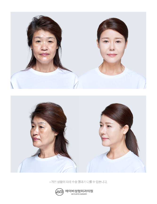 [에이비성형외과 방송출연] 엄마는예뻤다 7회 안성엄마병원 담당주치의 관련 이미지 4