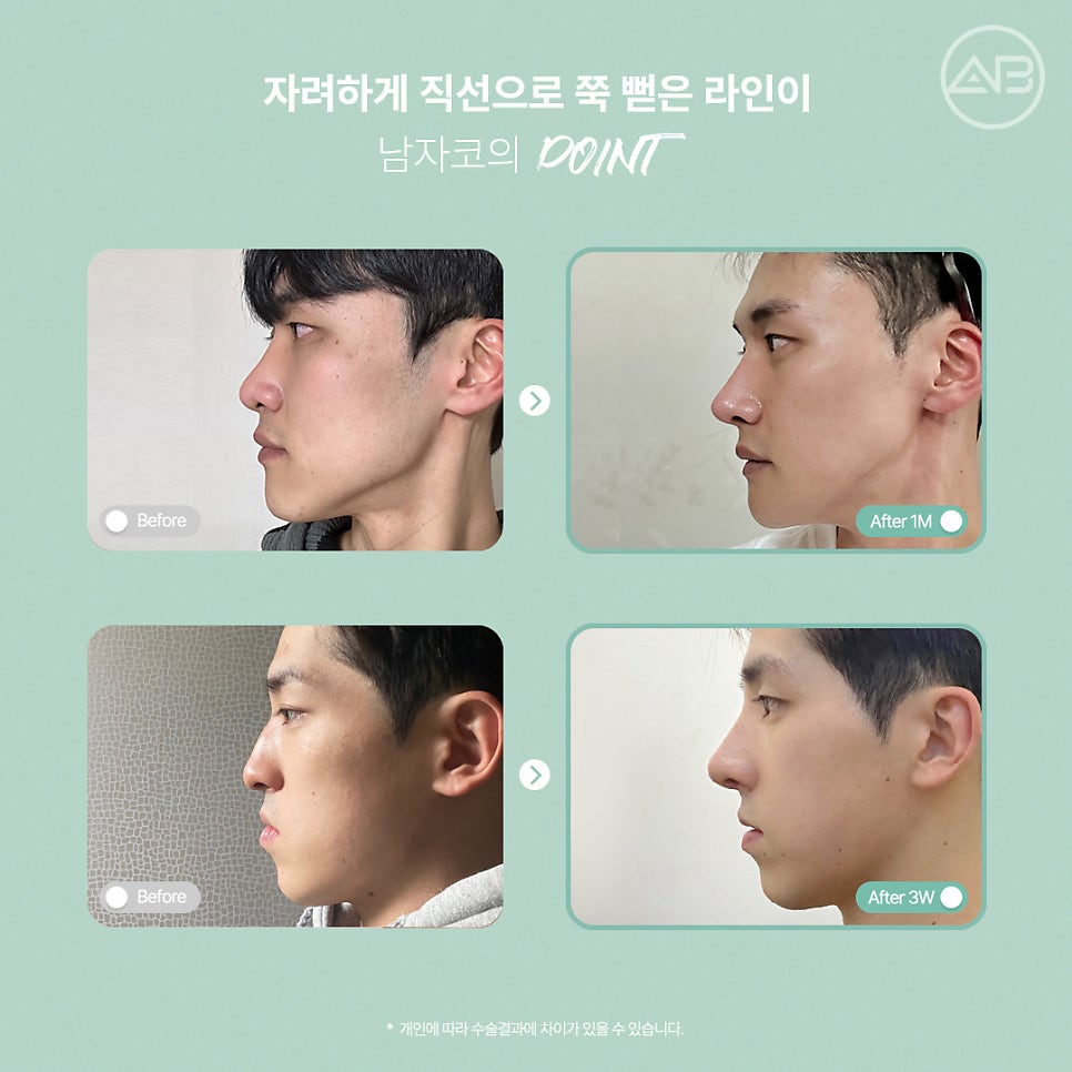 남자직선코성형, 남성적인 이미지 원한다면 에이비성형외과 관련 이미지 5