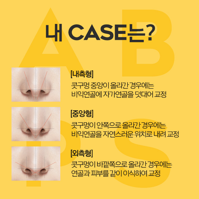 콧구멍이 보이는 것이 고민이라면 에이비 비공내리기 관련 이미지 4