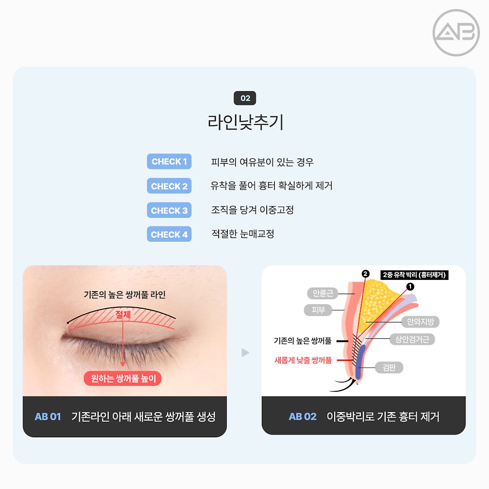 에이비성형외과 쌍꺼풀 짝눈 눈재수술종류 전후 관련 이미지 6