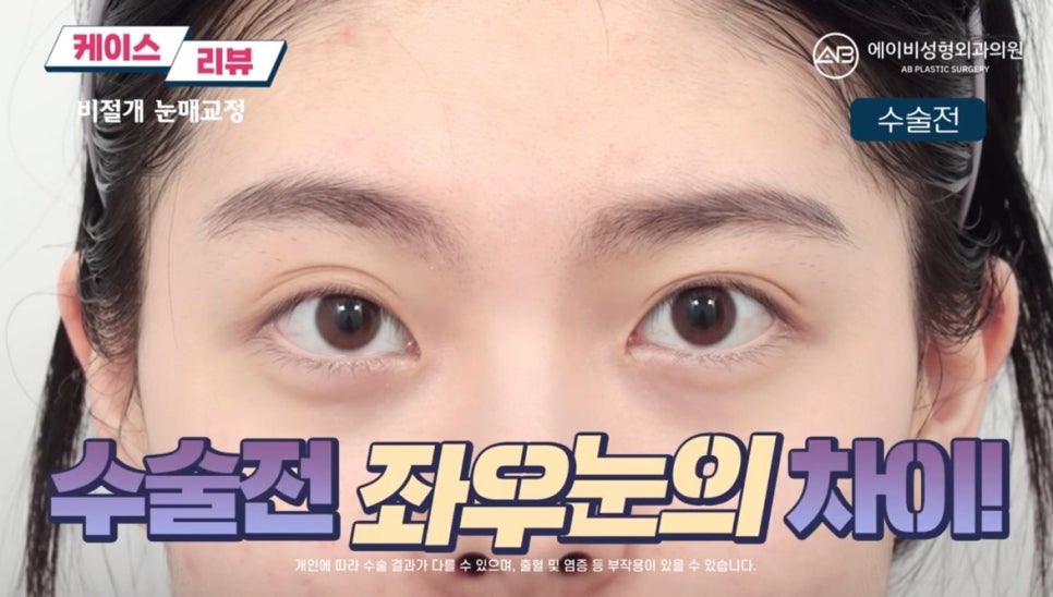 #AB Plastic Surgery #AB TV #Eye Surgery #Non-Incisional Ptosis Correction image 1