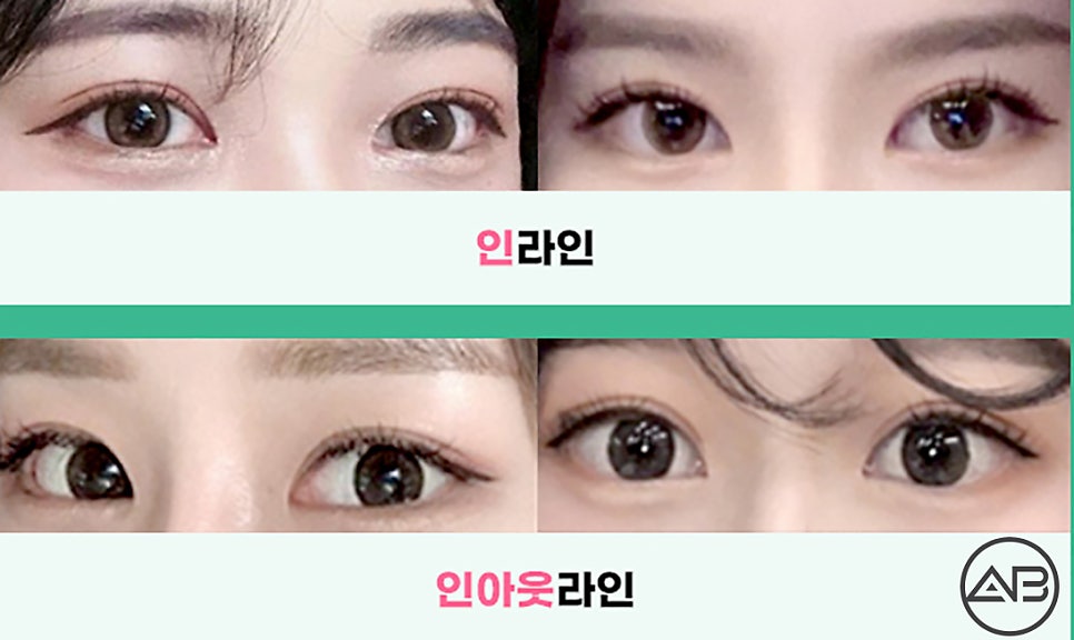 Q. 첫눈수술인데 세미아웃 인아웃의 차이점이 뭔가요? 관련 이미지 2